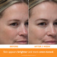 Side-by-side comparison of forehead and eye area showing skin texture before and after one week of treatment.