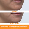 Close-up of lower face showing chin and lips with reduced visible discoloration compared to before image.