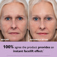 Before and after comparison of woman's face showing reduced wrinkles and lifted appearance around eyes and cheeks.