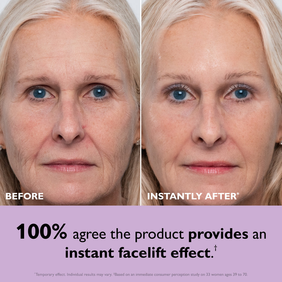 Before and after comparison of woman's face showing reduced wrinkles and lifted appearance around eyes and cheeks.