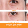 Close-up of eye area showing under-eye zone with visible fine lines and darker skin tone before treatment.