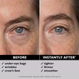 Before and after comparison of eye area showing reduced under-eye bags and wrinkles on right side.