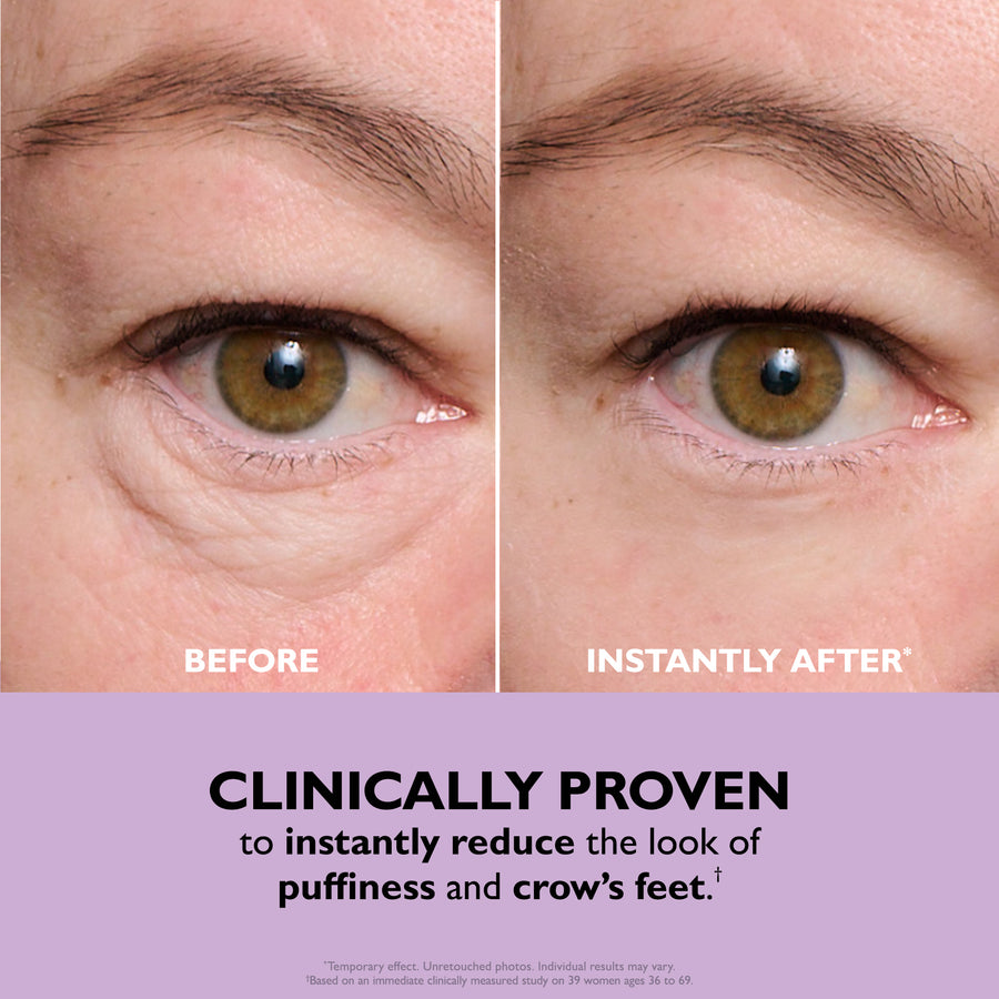 Before and after comparison of eye area showing reduced under-eye puffiness and smoothed skin texture.