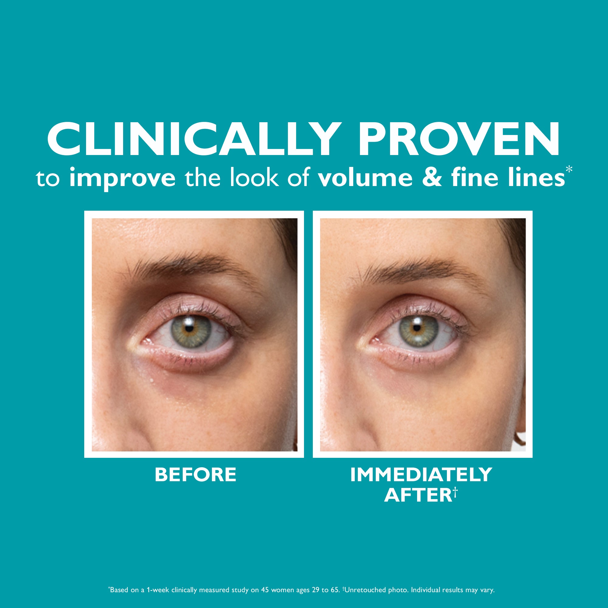 rm glutathione injection before and after HA Rejuve Results with & Hyaluronic Acid Microneedling & Photos New Jersey Before and After Glutathione: How