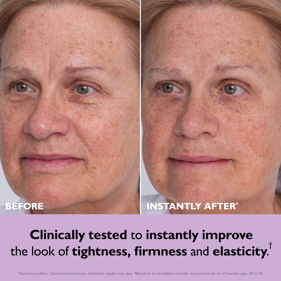 Before and after facial comparison showing reduced forehead wrinkles and smoother skin texture.