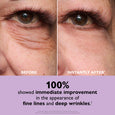 Before and after comparison of eye area showing reduced appearance of fine lines and wrinkles under the eye.