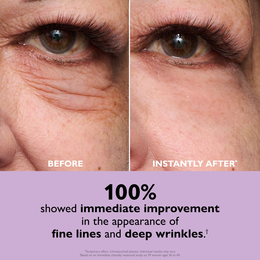 Before and after comparison of eye area showing reduced appearance of fine lines and wrinkles under the eye.