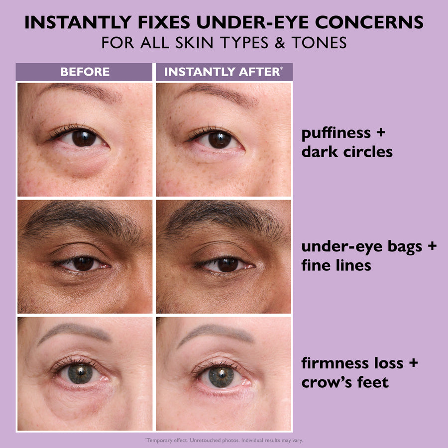 Before and after comparison showing eye area with reduced puffiness, dark circles, under-eye bags, fine lines, and crow's fee