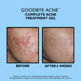 Before and after comparison of acne treatment on facial skin, showing reduced blemishes and redness over six weeks.