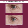 Before and after comparison of eye area showing reduced fine lines and smoother skin texture around the eye.