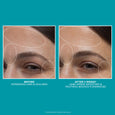 Before and after comparison of facial skin showing forehead and eye area with marked zones indicating reduced expression line