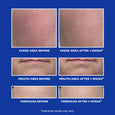 Before-and-after comparison showing cheek, mouth, and forehead skin texture changes on blue background.