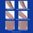 Six before-and-after comparison photos of skin on forearm, underarm, and leg areas on blue background.